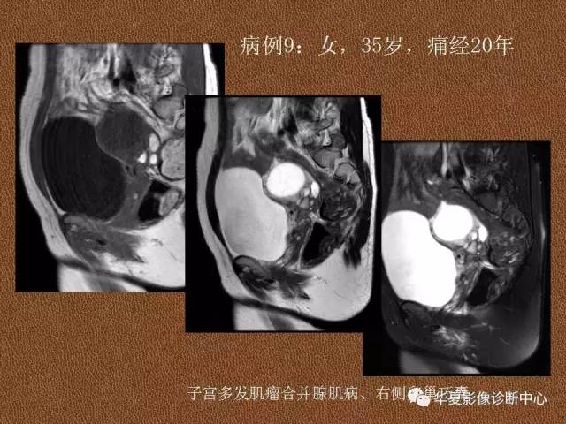 【PPT】子宫腺肌病