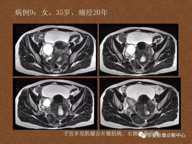 【PPT】子宫腺肌病