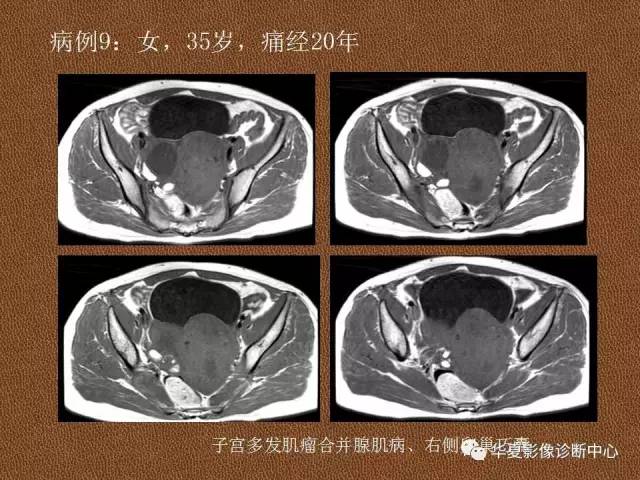 【PPT】子宫腺肌病
