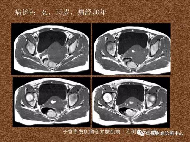 【PPT】子宫腺肌病