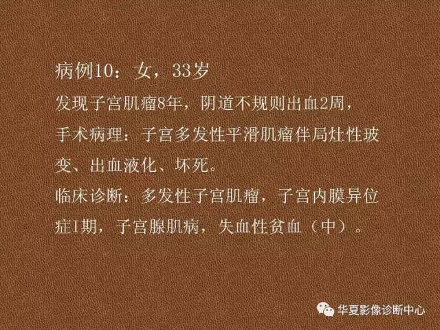 【PPT】子宫腺肌病