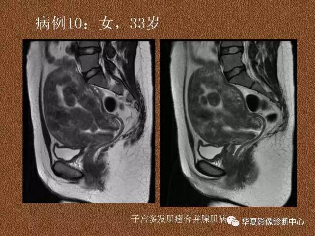 【PPT】子宫腺肌病