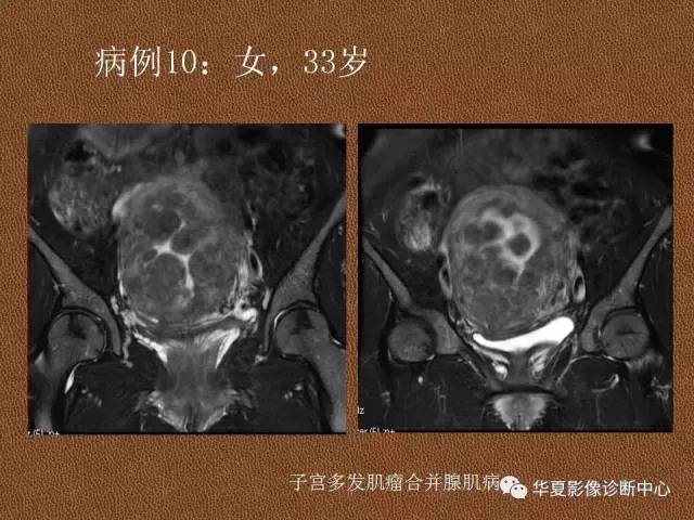 【PPT】子宫腺肌病