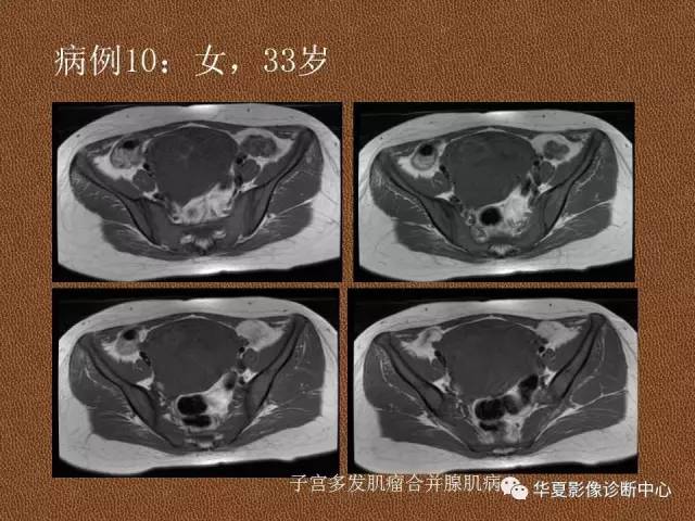 【PPT】子宫腺肌病