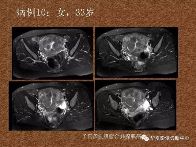 【PPT】子宫腺肌病