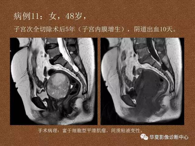 【PPT】子宫腺肌病