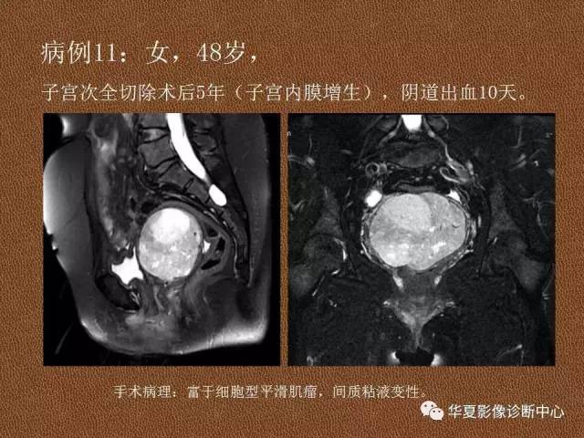 【PPT】子宫腺肌病