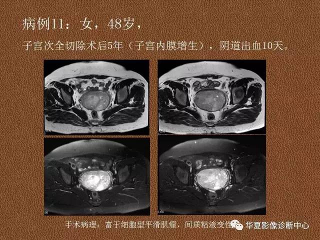 【PPT】子宫腺肌病