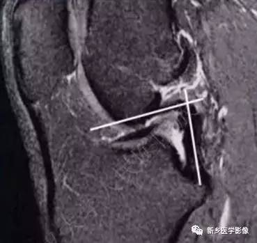 利用好这13种征象，诊断前交叉韧带损伤不再难