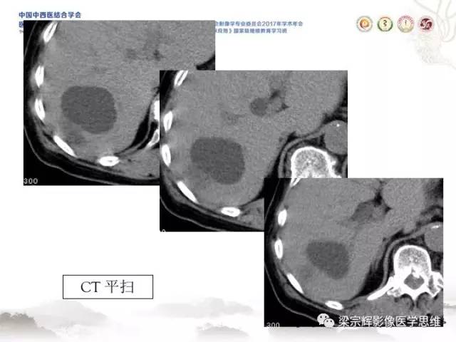 【病例】肝脏血管肌纤维母细胞瘤1例CT及MR
