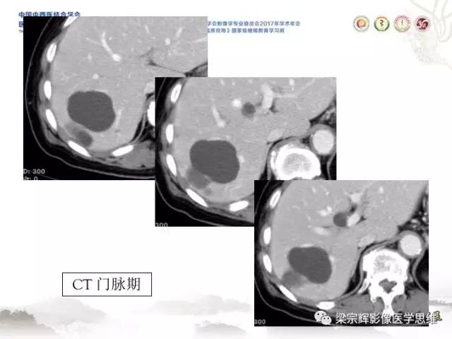 【病例】肝脏血管肌纤维母细胞瘤1例CT及MR