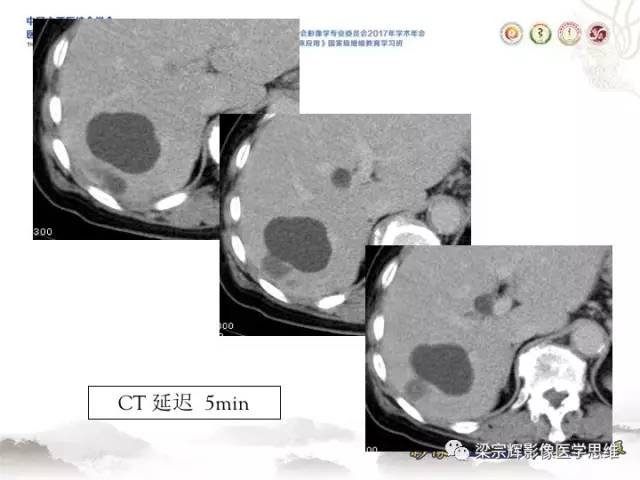【病例】肝脏血管肌纤维母细胞瘤1例CT及MR