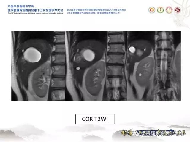 【病例】肝脏血管肌纤维母细胞瘤1例CT及MR