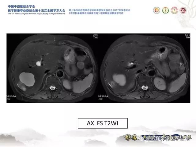 【病例】肝脏血管肌纤维母细胞瘤1例CT及MR