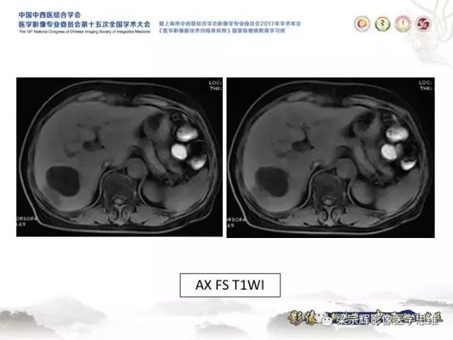 【病例】肝脏血管肌纤维母细胞瘤1例CT及MR