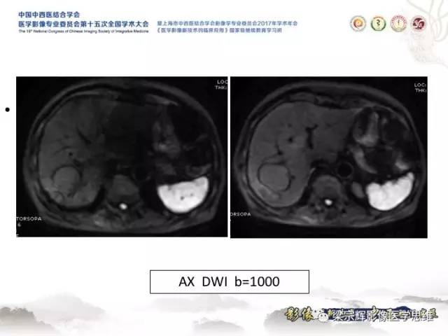 【病例】肝脏血管肌纤维母细胞瘤1例CT及MR