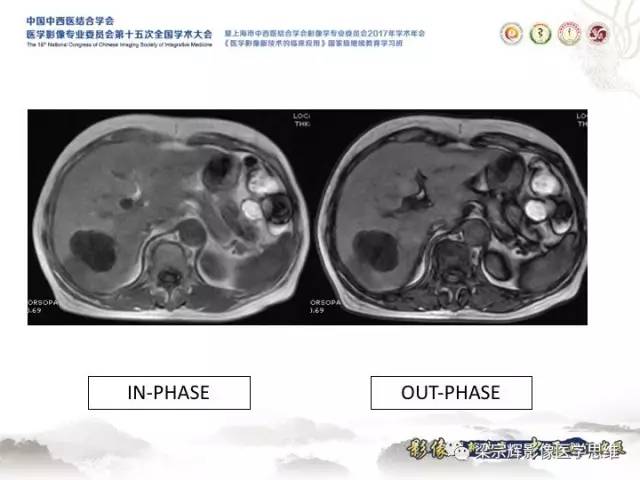 【病例】肝脏血管肌纤维母细胞瘤1例CT及MR