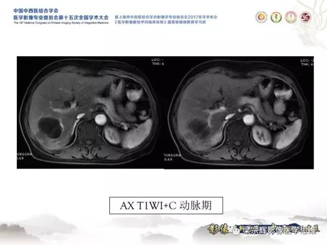 【病例】肝脏血管肌纤维母细胞瘤1例CT及MR