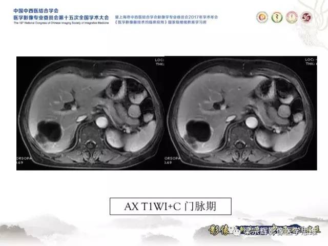 【病例】肝脏血管肌纤维母细胞瘤1例CT及MR
