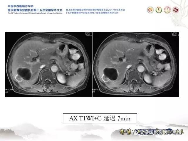 【病例】肝脏血管肌纤维母细胞瘤1例CT及MR