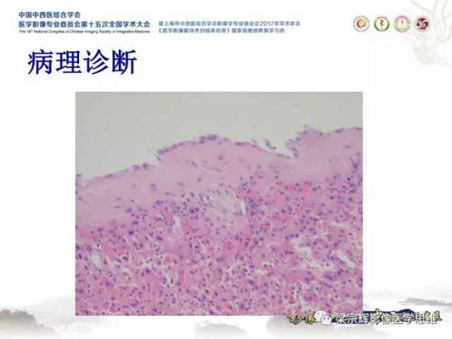 【病例】肝脏血管肌纤维母细胞瘤1例CT及MR
