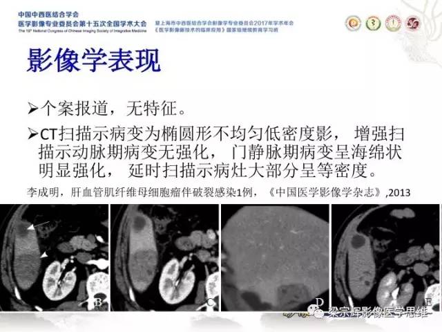 【病例】肝脏血管肌纤维母细胞瘤1例CT及MR