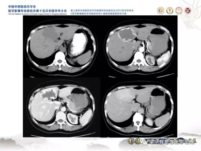 【病例】肝脏血管肌纤维母细胞瘤1例CT及MR
