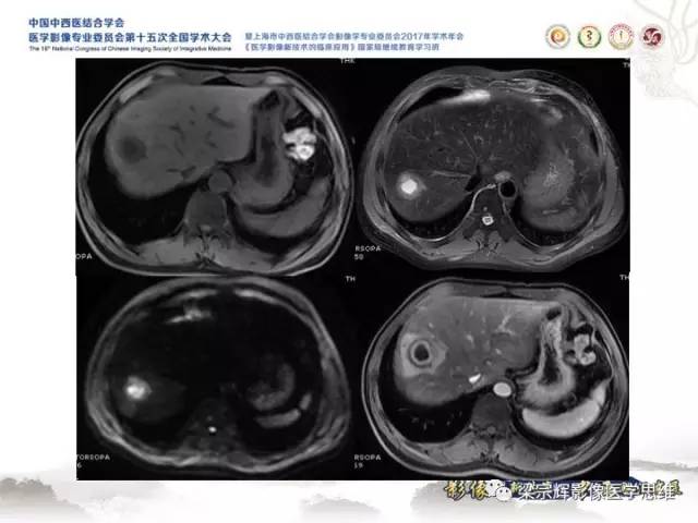 【病例】肝脏血管肌纤维母细胞瘤1例CT及MR