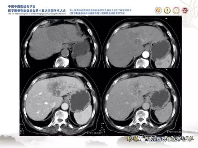 【病例】肝脏血管肌纤维母细胞瘤1例CT及MR