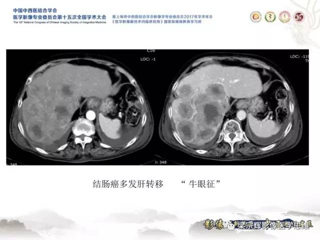 【病例】肝脏血管肌纤维母细胞瘤1例CT及MR