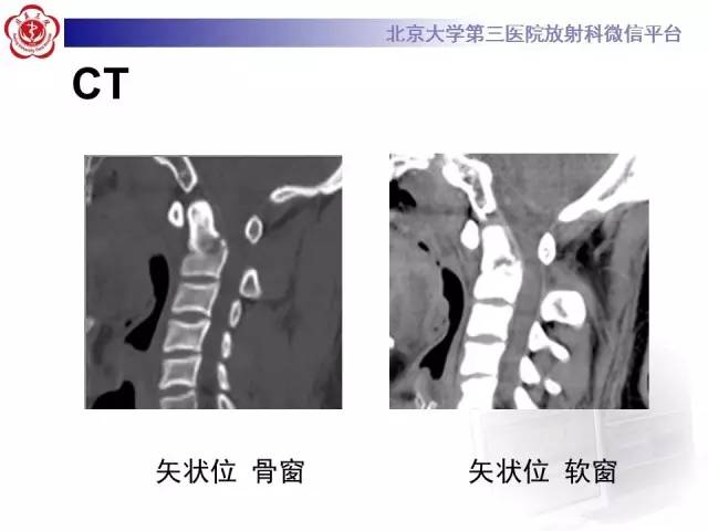 【病例】齿状突骨折1例CT及MR