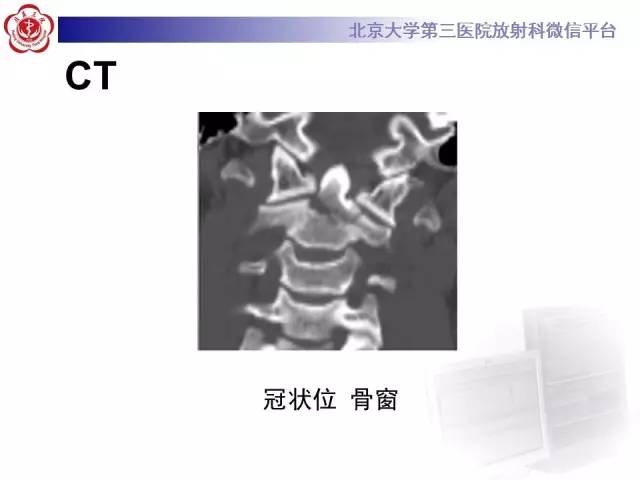 【病例】齿状突骨折1例CT及MR
