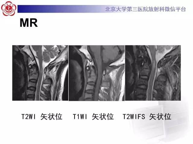 【病例】齿状突骨折1例CT及MR