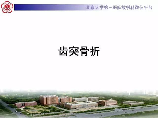 【病例】齿状突骨折1例CT及MR