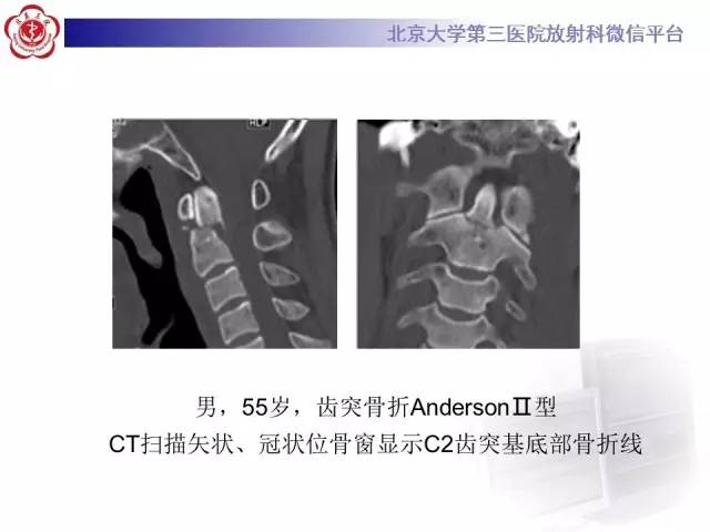 【病例】齿状突骨折1例CT及MR