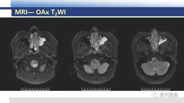 【PPT】鼻腔鼻窦孤立性纤维瘤影像诊断