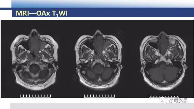 【PPT】鼻腔鼻窦孤立性纤维瘤影像诊断