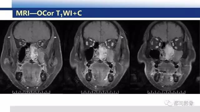 【PPT】鼻腔鼻窦孤立性纤维瘤影像诊断