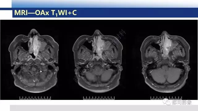 【PPT】鼻腔鼻窦孤立性纤维瘤影像诊断