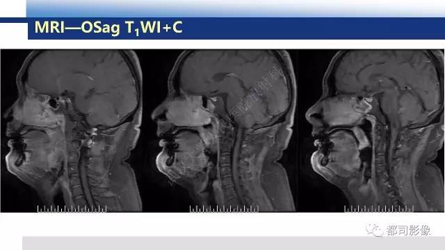 【PPT】鼻腔鼻窦孤立性纤维瘤影像诊断