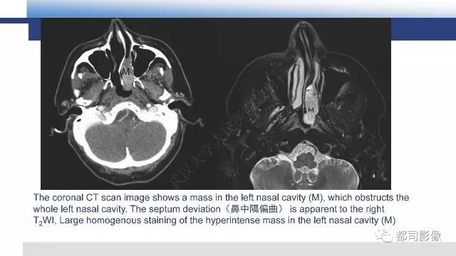 【PPT】鼻腔鼻窦孤立性纤维瘤影像诊断