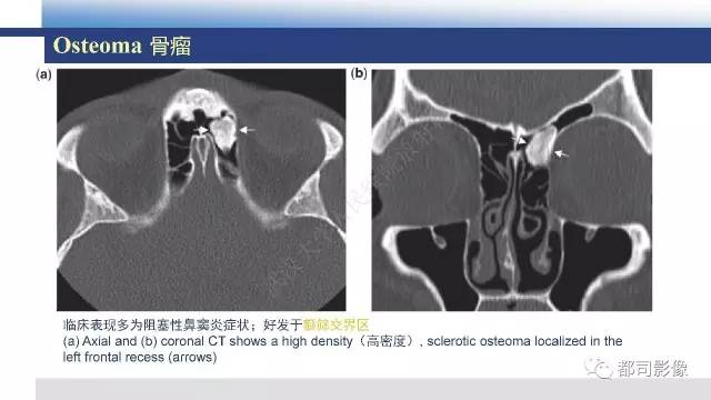 【PPT】鼻腔鼻窦孤立性纤维瘤影像诊断