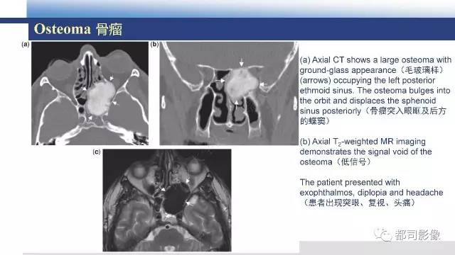 【PPT】鼻腔鼻窦孤立性纤维瘤影像诊断