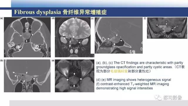 【PPT】鼻腔鼻窦孤立性纤维瘤影像诊断