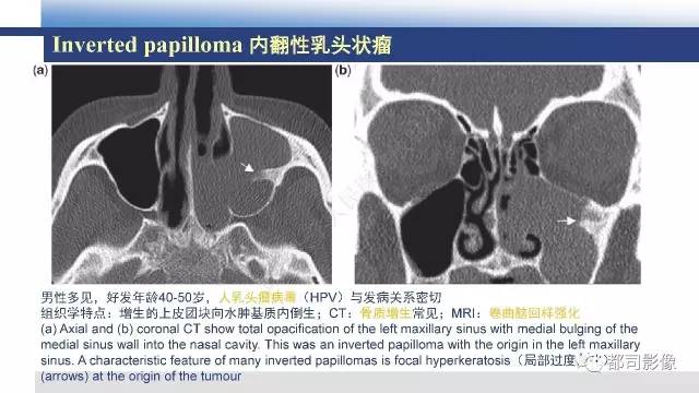 【PPT】鼻腔鼻窦孤立性纤维瘤影像诊断