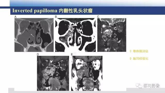 【PPT】鼻腔鼻窦孤立性纤维瘤影像诊断