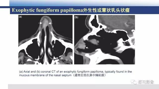 【PPT】鼻腔鼻窦孤立性纤维瘤影像诊断