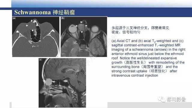【PPT】鼻腔鼻窦孤立性纤维瘤影像诊断