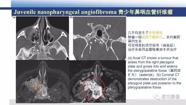 【PPT】鼻腔鼻窦孤立性纤维瘤影像诊断