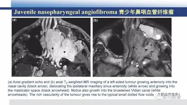 【PPT】鼻腔鼻窦孤立性纤维瘤影像诊断